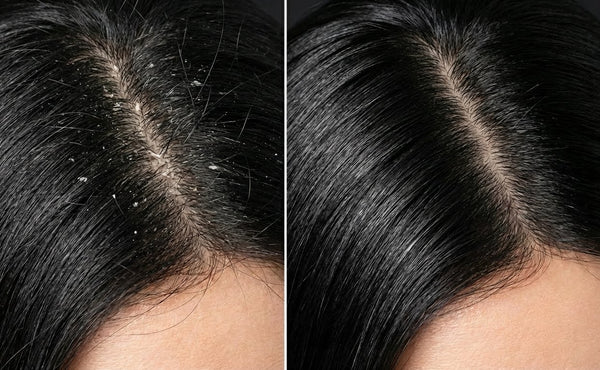 SHAMPOO ANTICASPA 300ml